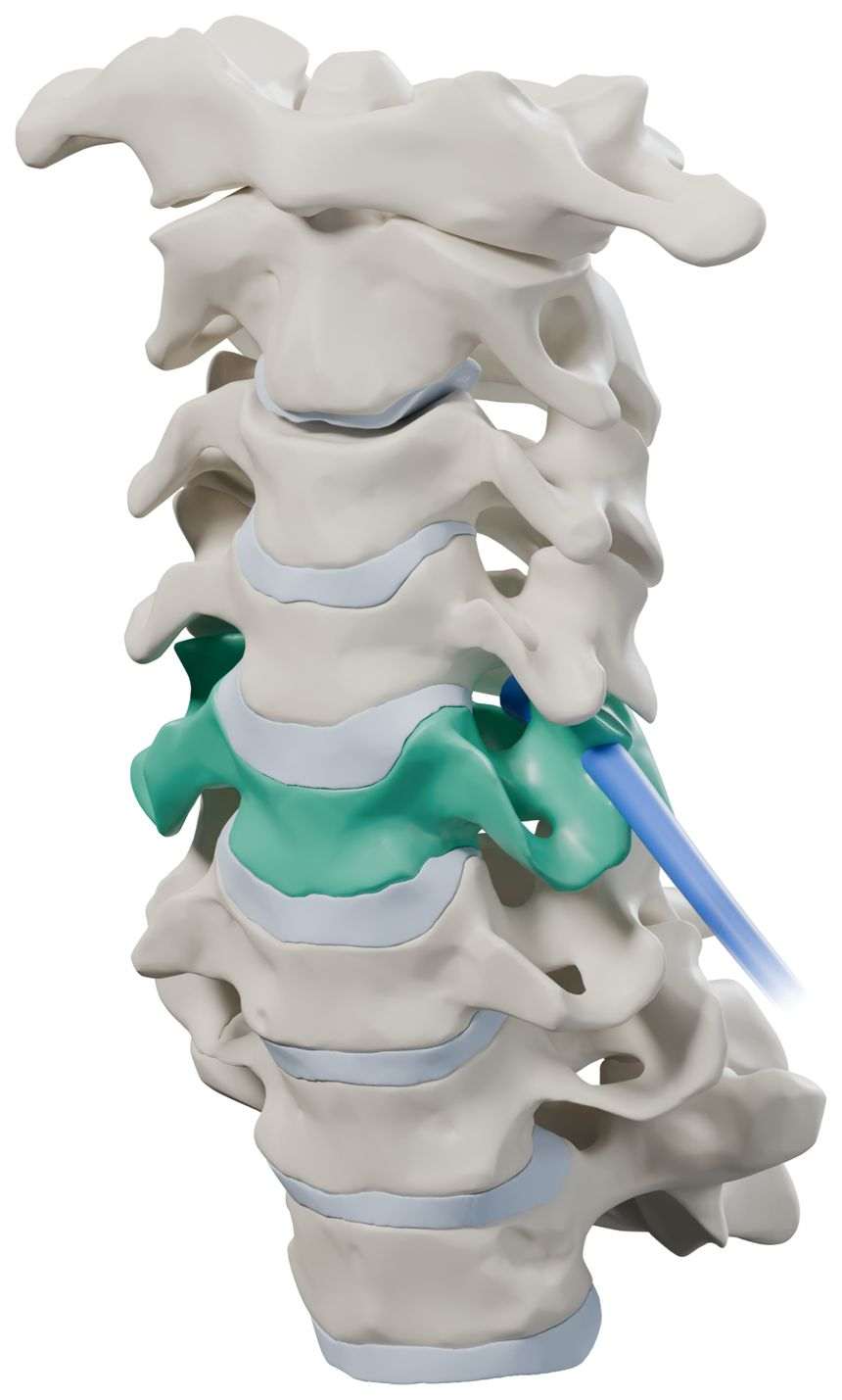 3D model of the cervical spine from C1 to T1, seen from the front and side. The fifth cervical vertebra, C5, is highlighted in teal, and the C5 nerve root leaves the spine beside it in blue.